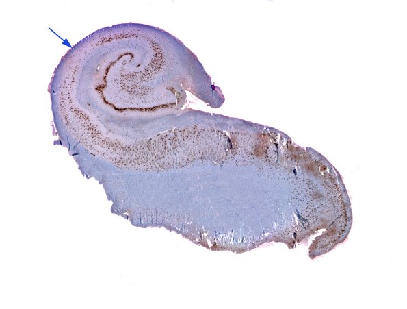 12A1 Hippocampal sclerosis (Case 12) NeuN whole mount