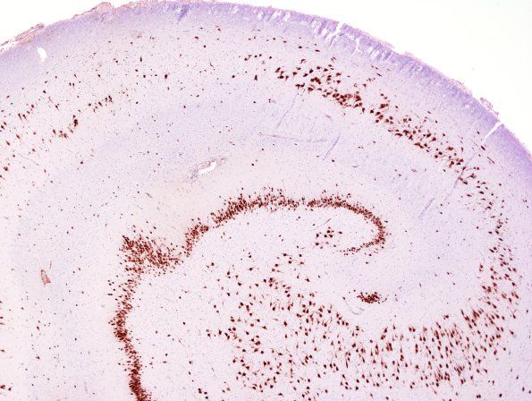 12A2 Hippocampal sclerosis (Case 12) NeuN 1