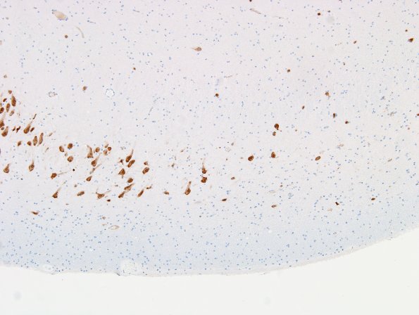 14 Hippocampal sclerosis (Case 14) NeuN 1