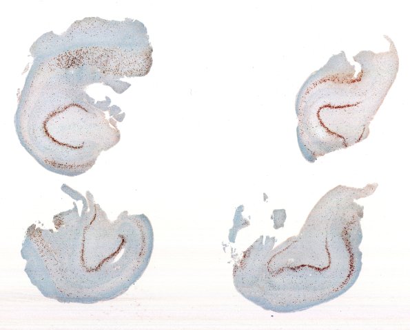 15 Hippocampal Sclerosis (Case 15) NeuN whole mount