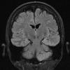 16A1 Hippocampal sclerosis (Case 16) FLAIR 1 - Copy