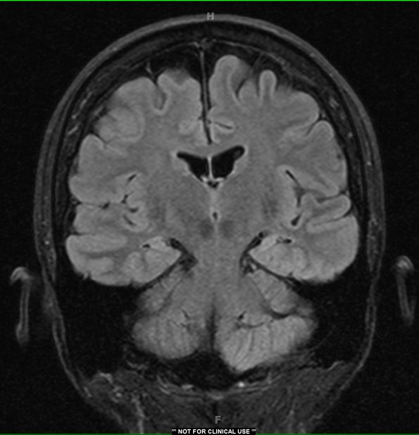 16A1 Hippocampal sclerosis (Case 16) FLAIR 1 - Copy