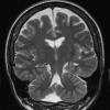 16A2 Hippocampal sclerosis (Case 16) T2 with contrast 1 - Copy