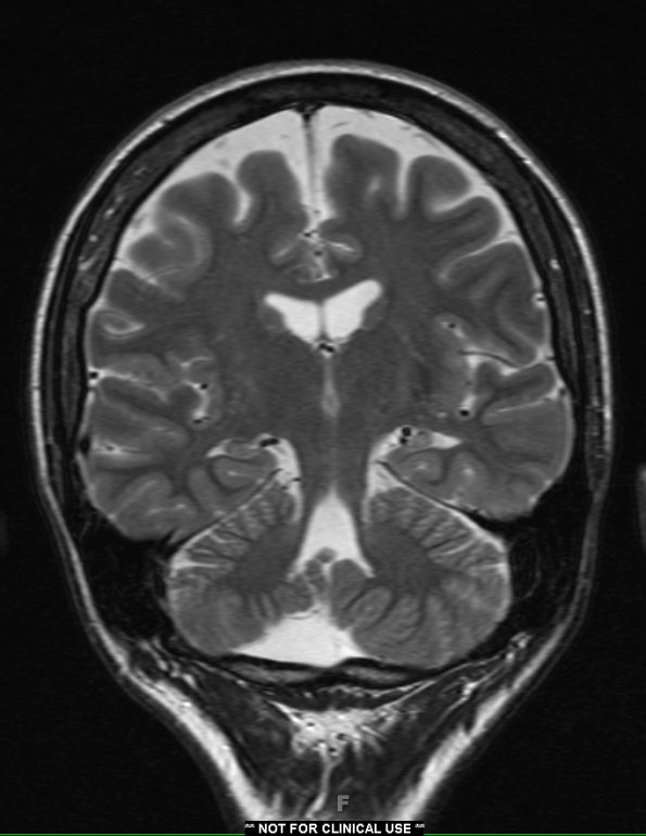 16A2 Hippocampal sclerosis (Case 16) T2 with contrast 1 - Copy