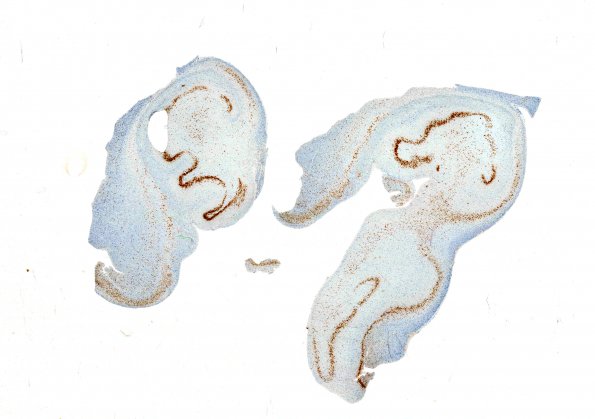 16B1 Hippocampal sclerosis (Case 16) NeuN WM