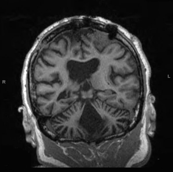 2A1 Hippocampal Sclerosis, chronic seizures, unilateral RX meningiomas(Case 2) COR MP-RAGE