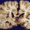 3A2 Hippocampal sclerosis (Chronic Sz Disorder, Case 3) 1