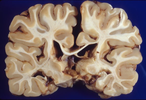 3A2 Hippocampal sclerosis (Chronic Sz Disorder, Case 3) 1