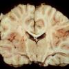 4A1 Hippocampal sclerosis, mesial temporal sclerosis, chronic Sz 7yo (Case 4) 3