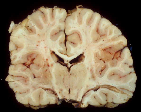 4A1 Hippocampal sclerosis, mesial temporal sclerosis, chronic Sz 7yo (Case 4) 3