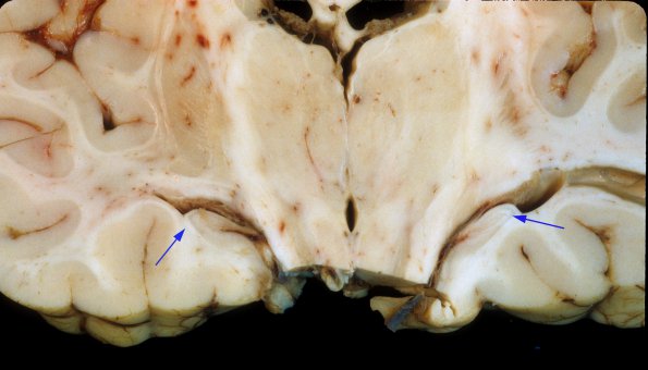 4A2 Hippocampal sclerosis, mesial temporal sclerosis, chronic Sz 7yo (Case 4) 1