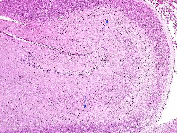 4B1 Hippocampal sclerosis, mesial temporal sclerosis, chronic Sz 7yo (Case 4) H&E 3