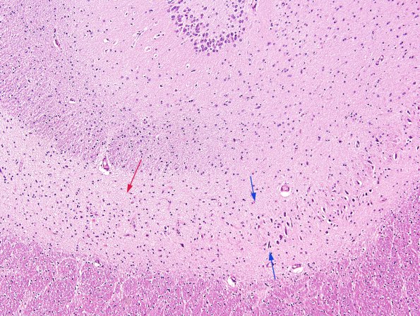 4B3 Hippocampal sclerosis, mesial temporal sclerosis, chronic Sz 7yo (Case 4) H&E 4