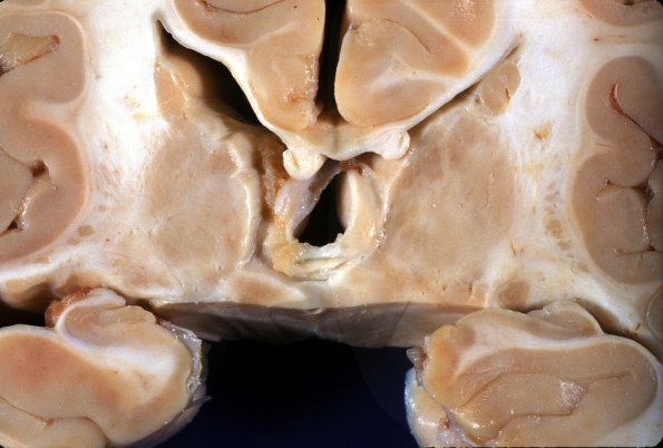 5 Hippocampal Sclerosis (Case 5) gross 1