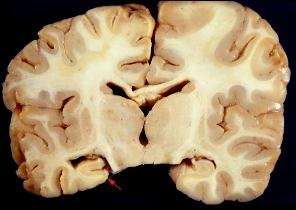 6A1 Hippocampal sclerosis Unilateral HC sclerosis (Case 6)