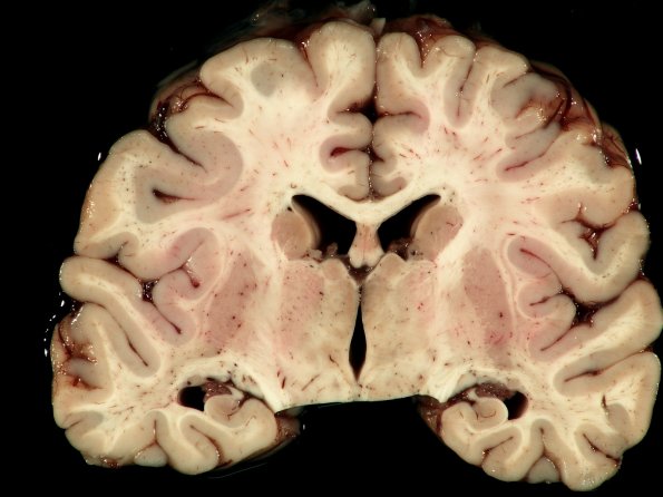 7 Seizure disorder, chronic (Case 7) _2