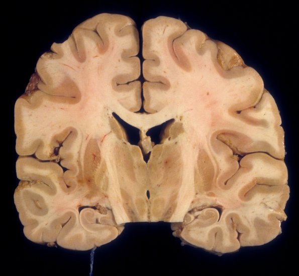 8 Hippocampal sclerosis, seizure disorder (Case 8) 3