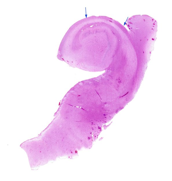 9A1 Hippocampal sclerosis (Case 9) H&E whole mount