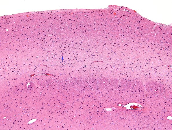 9A2 Hippocampal sclerosis (Case 9) Sommer's sector H&E