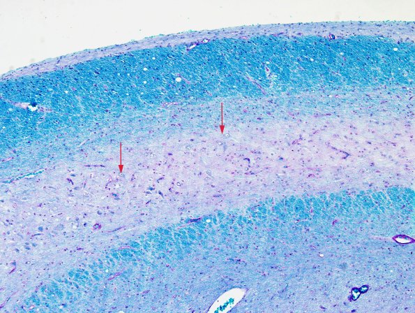 9B2 Hippocampal sclerosis (Case 9) LFB-PAS whole mount