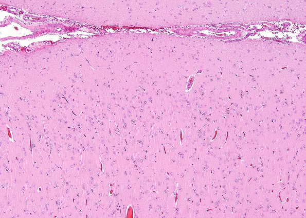 1A1 Hyaline Astrocytopathy (Case 1) H&E 8