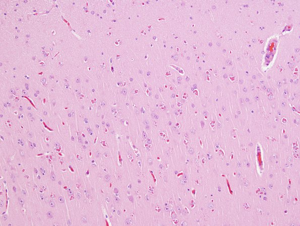 1A2 Hyaline Astrocytopathy (Case 1) H&E 5