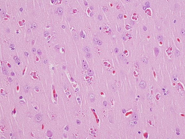 1A3 Hyaline Astrocytopathy (Case 1) H&E 4