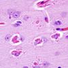 1A4 Hyaline Astrocytopathy (Case 1) H&E 10