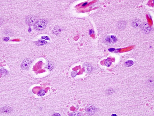 1A4 Hyaline Astrocytopathy (Case 1) H&E 10