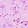 1A5 Hyaline Astrocytopathy (Case 1) H&E 11