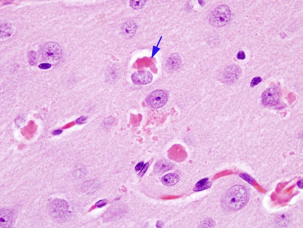 1A5 Hyaline Astrocytopathy (Case 1) H&E 11