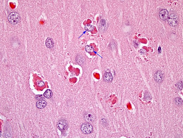 1A6 Hyaline Astrocytopathy (Case 1) H&E 100X 