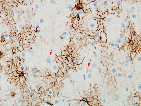 1B1 Hyaline Astrocytopathy (Case 1) GFAP 2