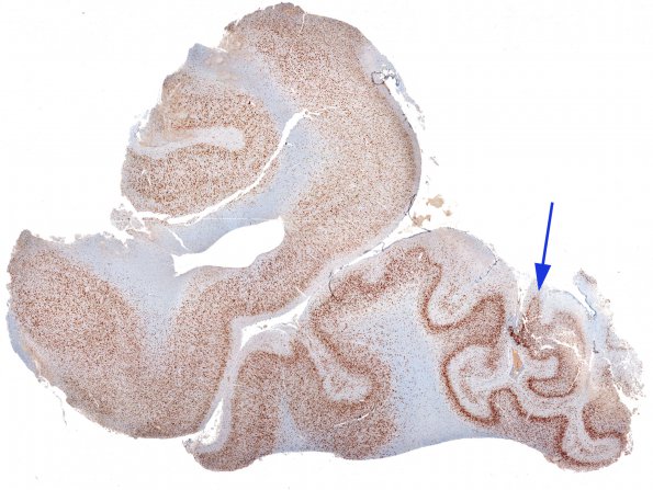 1B2 Hyaline Astrocytopathy and polymicrogyria (Case 1) NeuN whole mount