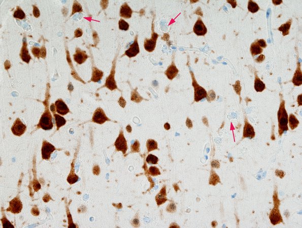 1B3 Hyaline Astrocytopathy (Case 1) NeuN 2