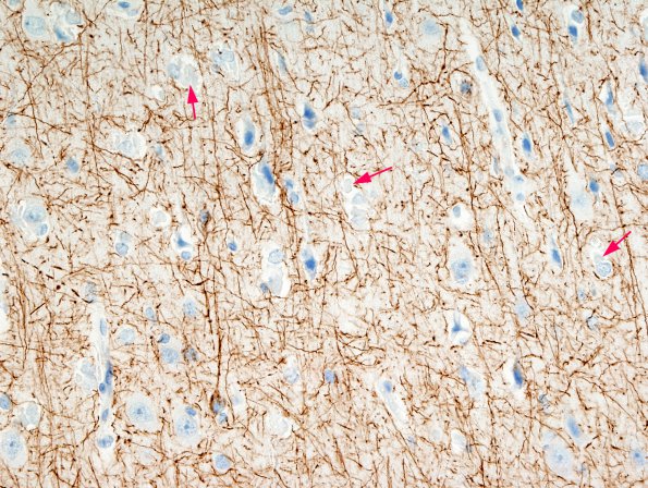 1B4 Hyaline Astrocytopathy (Case 1) NF 1A