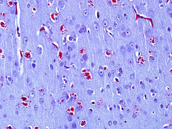 1B5 Hyaline Astrocytopathy (Case 1) Trichrome 3