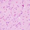 2A1 Hyaline Astrocytopathy (Case 2) H&E 3