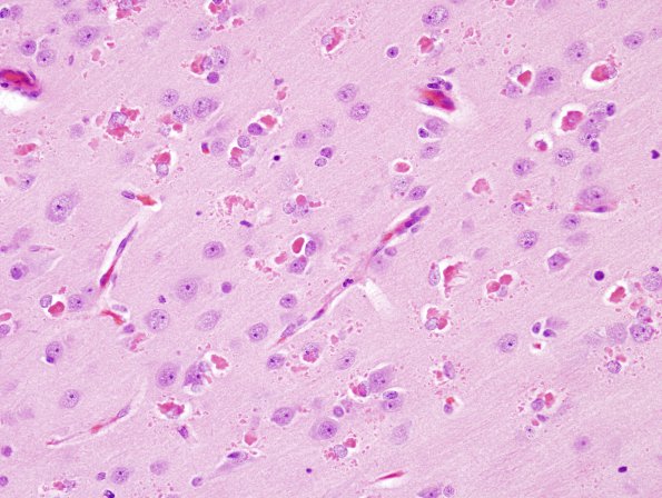 2A1 Hyaline Astrocytopathy (Case 2) H&E 3