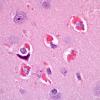 2A2 Hyaline Astrocytopathy (Case 2) H&E 100X 