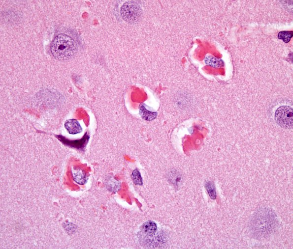 2A2 Hyaline Astrocytopathy (Case 2) H&E 100X 