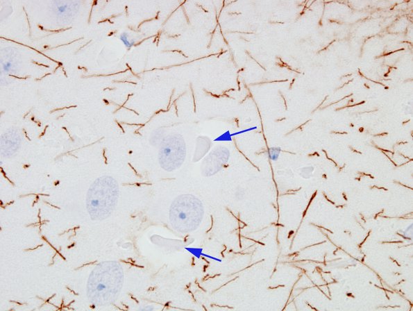 2B1 Hyaline Astrocytopathy (Case 2) GFAP 4