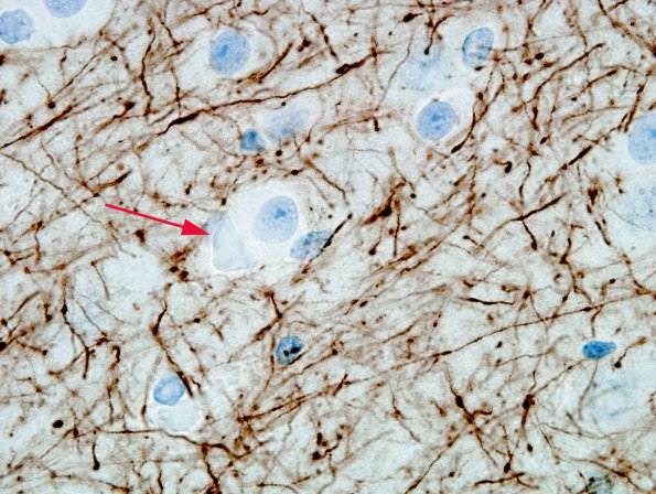 2B4 Hyaline Astrocytopathy (Case 2) NFil 1