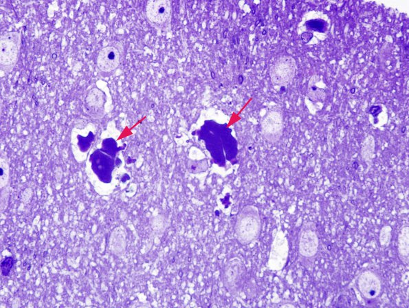 2C1 Hyaline Astrocytopathy (Case 2) Plastic 1