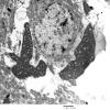 2C2 Hyaline Astrocytopathy (Case 2) EM 2 - Copy