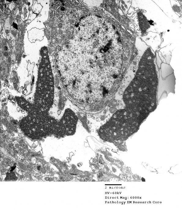 2C2 Hyaline Astrocytopathy (Case 2) EM 2 - Copy