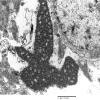 2C3 Hyaline Astrocytopathy (Case 2) EM 3 - Copy