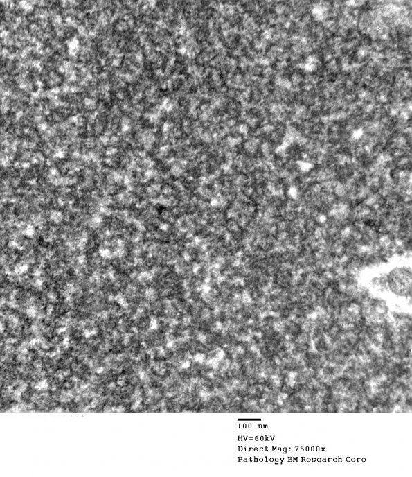 2C4 Hyaline Astrocytopathy (Case 2) EM 1 - Copy