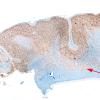 1A1 Microdysgenesis (Case 1) whole mount NeuN