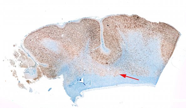 1A1 Microdysgenesis (Case 1) whole mount NeuN